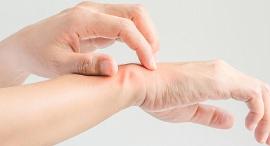 Türkiye'de uyuz vakaları neden artıyor? Uyuz nasıl tedavi edilir? 