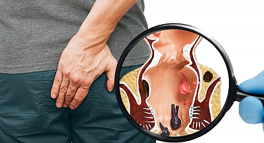 Basur (hemoroid) can yakıyor! Uzmanlar uyarıyor: 'Bu alışkanlıklarınızı hemen bırakın'