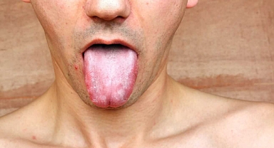 Frengi geri döndü! Uzmanlar uyarıyor: 'Bu belirtileri görürseniz hemen test yaptırın'