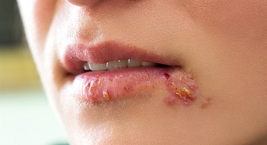 Herpes Simpleks virüsü (uçuk) sessizce yayılıyor: Her 3 kişiden 1’inde var!
