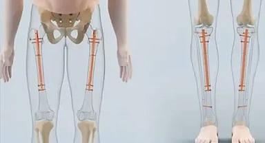 Santim santim hayallere uzanan tehlikeli yolculuk! Boy uzatma ameliyatının bilinmeyen riskleri ortaya çıktı!