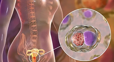 Trikomonas alarmı: Her 5 kadından 1'inde görülüyor! 