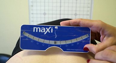 Mersin Büyükşehir Belediyesi Kadın Sağlığı Danışma Merkezi’nden skolyoz hastalarına destek