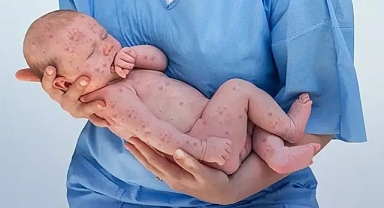 Aşı reddinin faturası ağır: Kızamık 25 yılın zirvesinde