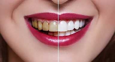 Evde mi klinikte mi? Diş beyazlatmada doğru yöntemi uzmanlar açıkladı