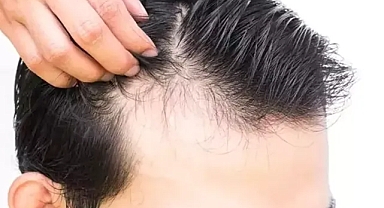 Havalar soğudu, saç nezlesi vakaları artıyor: Saçlarınız dökülebilir