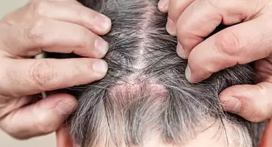 Saç derisinde aniden çıkan sivilce ve yaralar: Neden olur, nasıl geçer?