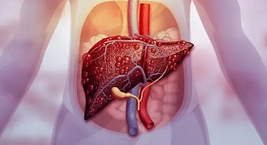 Karaciğer yağlanması kader değil: Sirozdan dönmenin formülü belli oldu