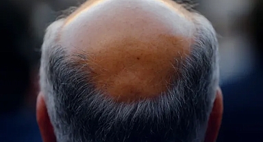 Kellik tarih oluyor: Yeni ilaçla saç çıkışı yüzde 539 arttı