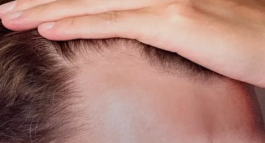 Kellikte 30 yıl sonra devrim: Yeni ilaç saç çıkarıyor